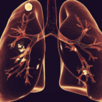 bronchiolitis