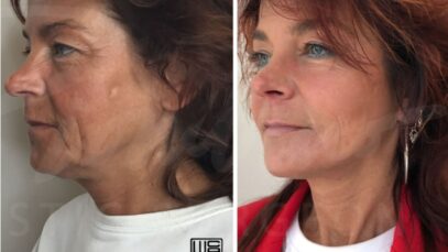 Face lift: what is and what to expect